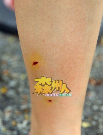 恶犬利齿咬住李金婷的小腿，留下齿痕，伤口尚未结疤。