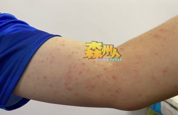 谢琪清的手臂上出现大量红疹，一片泛红。